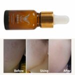 ROYAL Folliculitis Goose Pimple Remover  10ml - Asian Remedy - Removes Dead Skin - Image 3