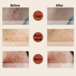 ROYAL Folliculitis Goose Pimple Remover  10ml - Asian Remedy - Removes Dead Skin - Image 6