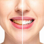 Vegan Teeth Whitening